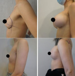 Breast-Augmentation-296X300