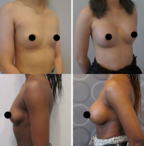 Breast-Augmentation1-296X300