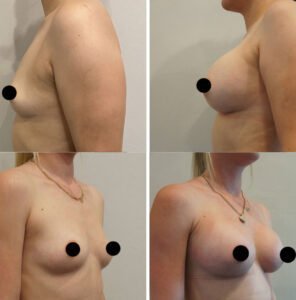 Breast-Augmentation2-296X300