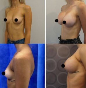 Breast-Augmentation4-296X300