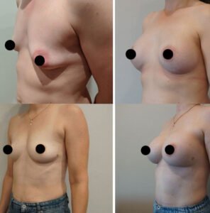 Breast-Augmentation5-296X300