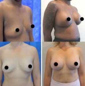 Breast-Augmentation6-296X300